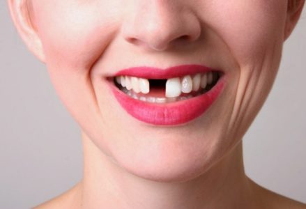 Cách ngăn chặn rụng răng sớm