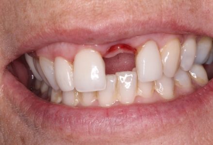 Cắm implant răng cửa 