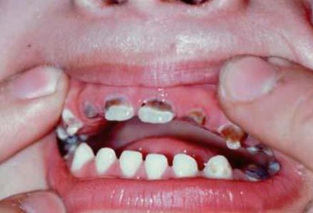 Chăm sóc răng miệng cho trẻ theo cách của người Nhật