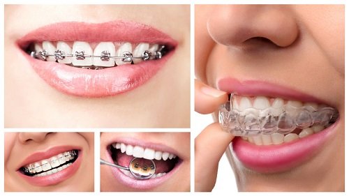 Giải pháp tốt nhất điều trị răng hô 3