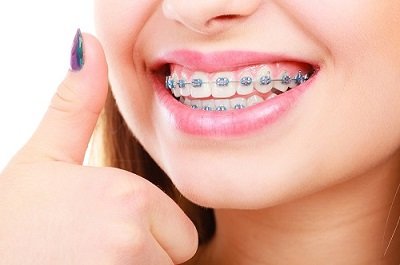 Giải pháp tốt nhất điều trị răng hô 4