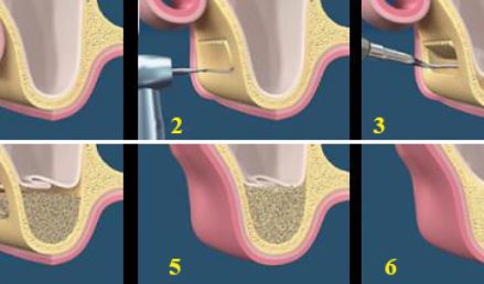 nâng xoang hàm trong cấy ghép implant