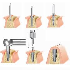 nâng xoang hàm trong cấy ghép implant
