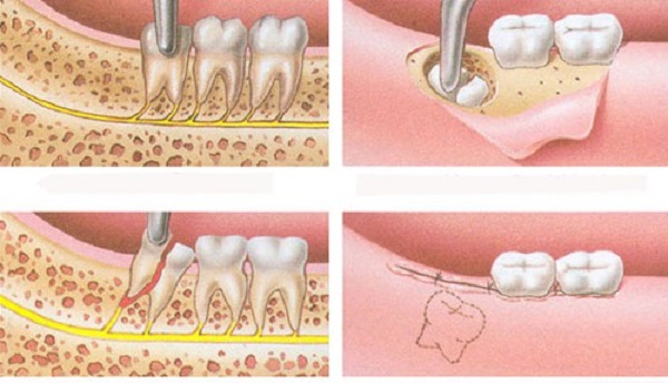 Mọc 4 cái răng khôn cùng lúc nên xử lý ra sao? 3