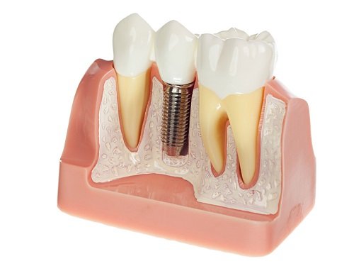 Những câu hỏi về implant 2