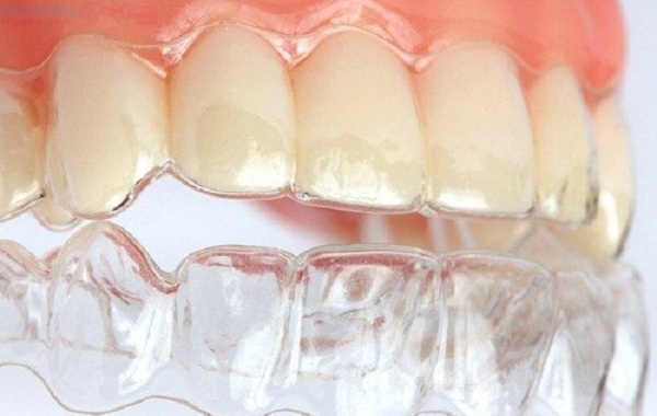 Niềng răng invisalign có lợi ích gì? 2