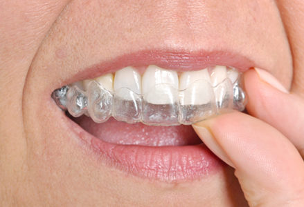 niềng răng invisalign có tốt không