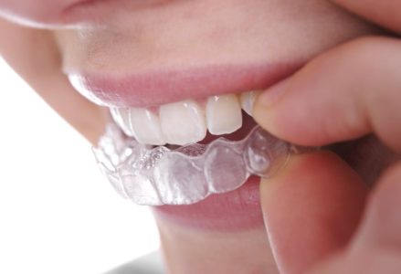 Quy trình tẩy trắng răng tại nhà như thế nào