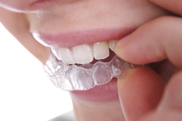 Niềng răng invisalign có lợi ích gì? 1
