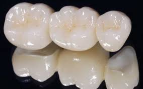 Răng sứ cercon và răng sứ titan có bền không? 1