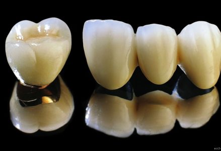 Răng sứ titan có độ bền như thế nào ?