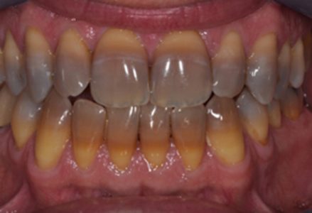 tác hại do thuốc lá gây ra với răng miệng