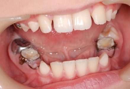 bọc răng sứ cho răng hàm