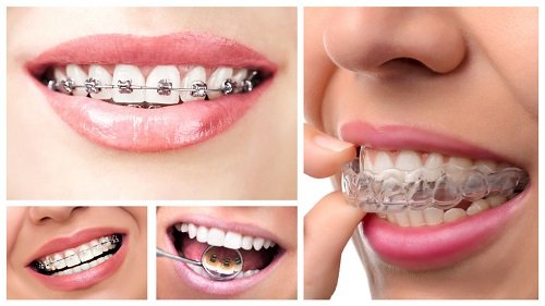 Cấu trúc hàm răng khi niềng răng không cần nhổ răng 1