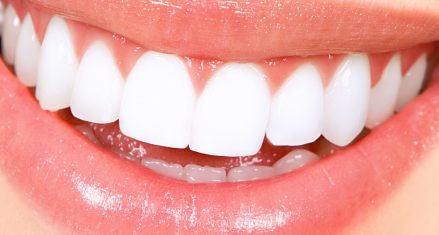Ê buốt răng sau khi tẩy trắng