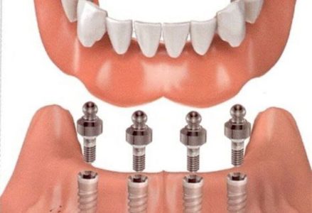 nên bọc răng sứ hay cấy ghép implant