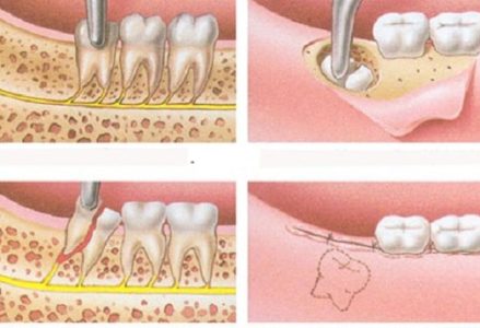 nhổ răng khôn khi mang thai có nguy hiểm không