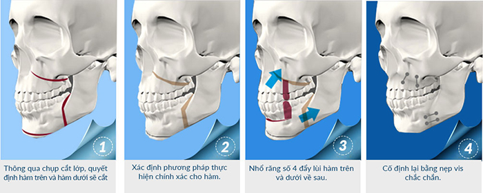 phẫu thuật cắt xương hàm