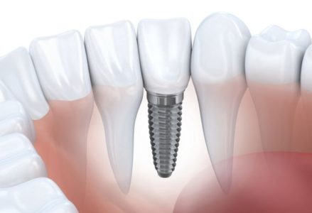 phương pháp trồng răng implant cố định