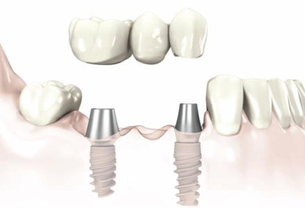 phương pháp trồng răng implant cố định