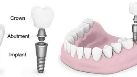 phương pháp trồng răng implant cố định