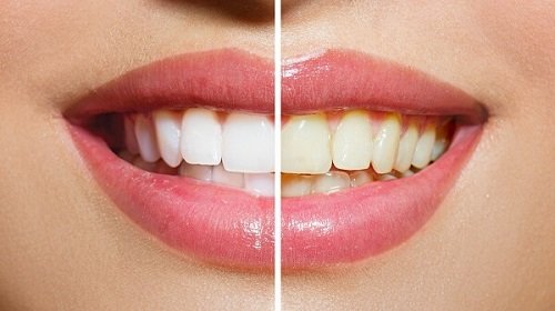 Quy trình và chi phí tẩy trắng răng 2