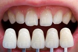 Răng trắng đục có cách khắc phục không?