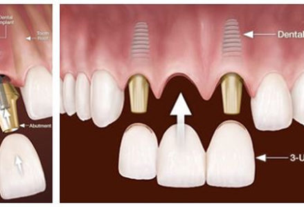 Trồng răng cửa có đau không