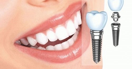 Vì sao có trường hợp cần ghép xương khi cấy implant 1