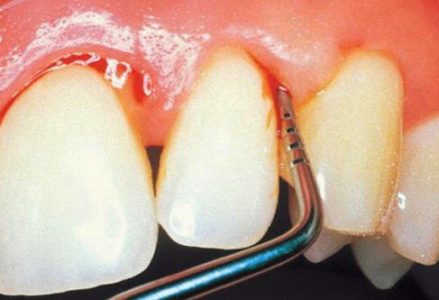 Viêm chân răng và cách điều trị