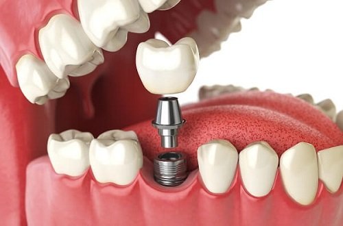 Bác sỹ tư vấn: Trồng răng hàm có đau không? 3