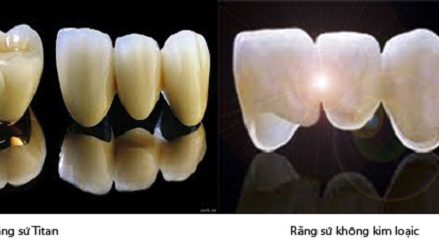 Bọc răng sứ giá bao nhiêu tiền ?