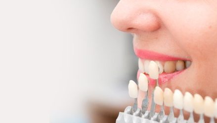 Giá bọc răng sứ veneer bao nhiêu tiền? 