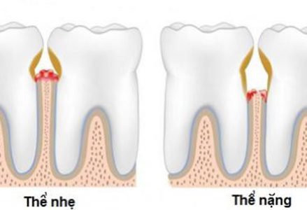 Chảy máu nướu răng đừng xem nhẹ