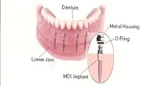 Địa chỉ trồng răng implant tốt nhất ở đâu?