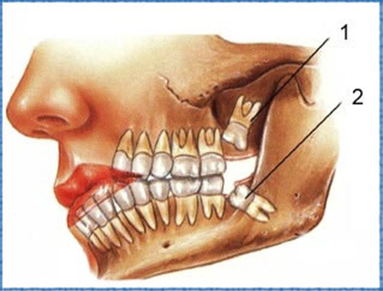 Răng khôn có phải răng số 8 không? Tìm hiểu 1