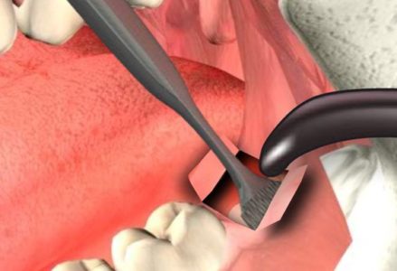 Phương pháp nhổ răng hàm không đau
