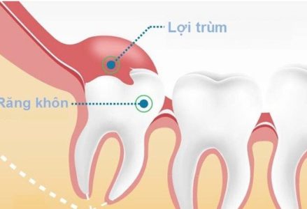 Sưng nướu răng trong cùng là tình trạng răng miệng gì?