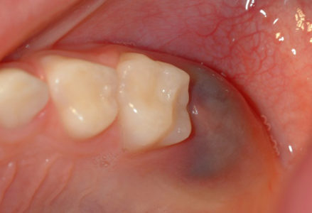 Sưng nướu răng trong cùng là tình trạng răng miệng gì?
