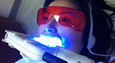 tẩy trắng răng bằng laser giá bao nhiêu