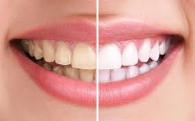 Tẩy trắng răng thẩm mỹ giúp răng đẹp tự nhiên 