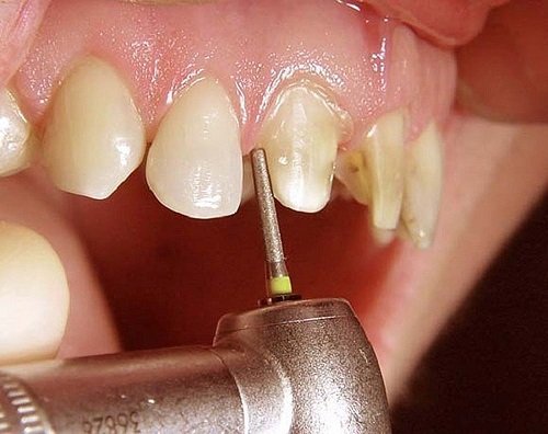 Tổng hợp vấn đề cần chú ý khi bọc răng sứ 1