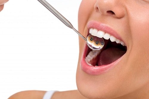 Niềng răng mắc cài mặt lưỡi hiệu quả ra sao? 1