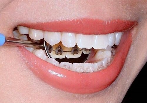 Niềng răng mắc cài mặt lưỡi hiệu quả ra sao? 2