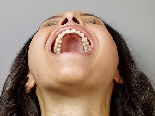 Niềng răng mắc cài mặt lưỡi hiệu quả ra sao? 3