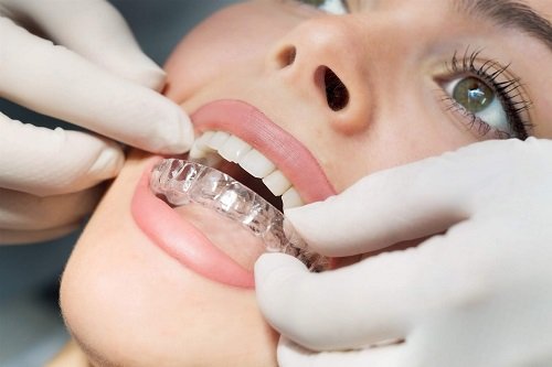 Niềng răng 1 hàm có đau không? Quy trình thực hiện 3