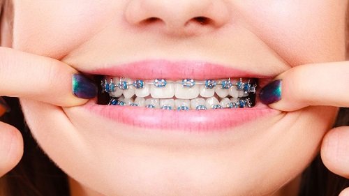Niềng răng có nguy hiểm không? Tình trạng nào hay gặp khi niềng răng 1