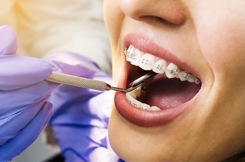 Niềng răng có nguy hiểm không? Tình trạng nào hay gặp khi niềng răng 2