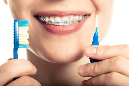 Niềng răng có nguy hiểm không? Tình trạng nào hay gặp khi niềng răng 4