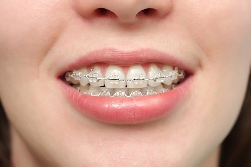 Niềng răng hô mất thời gian bao lâu là có kết quả? 1